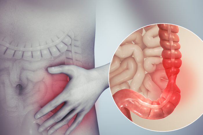 3 Tips for People Living with Irritable Bowel Syndrome
